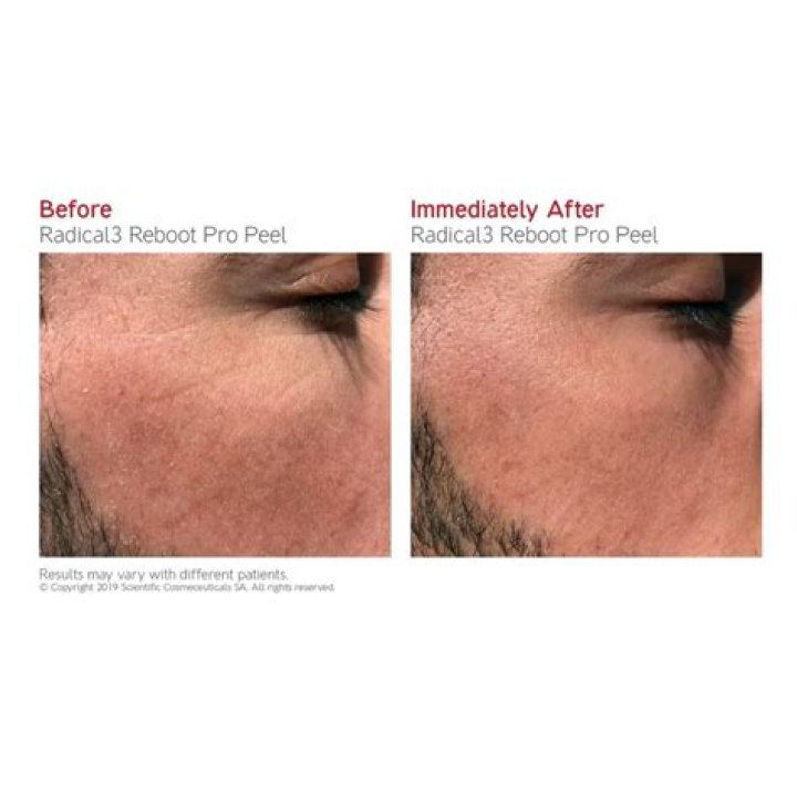 Radical3 Reboot Pro Peel Radical3 Reboot Pro Peel